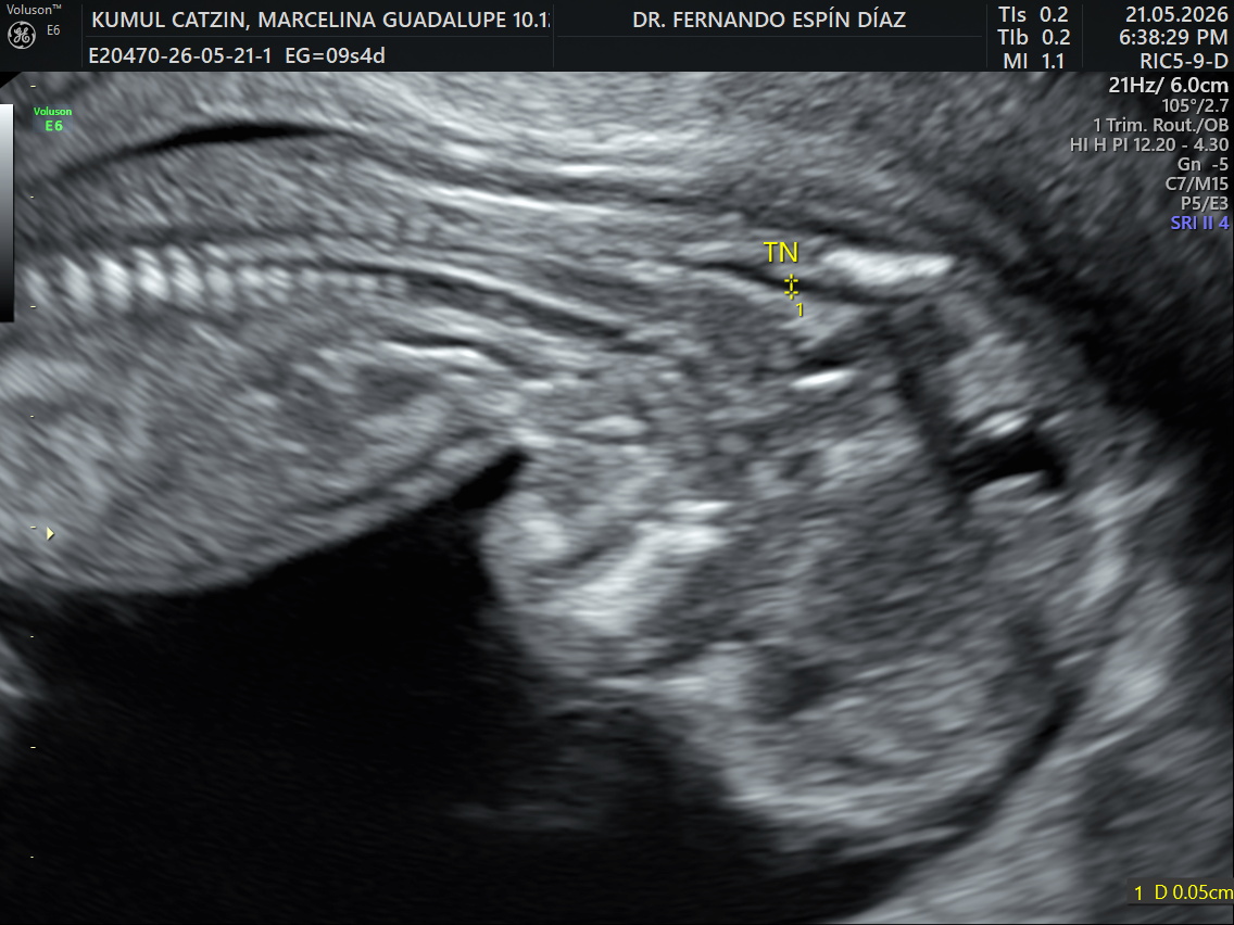 Ultrasonido estructural de 11–14 semanas